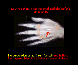 Röntgenbild einer Hand mit Bio-Chip